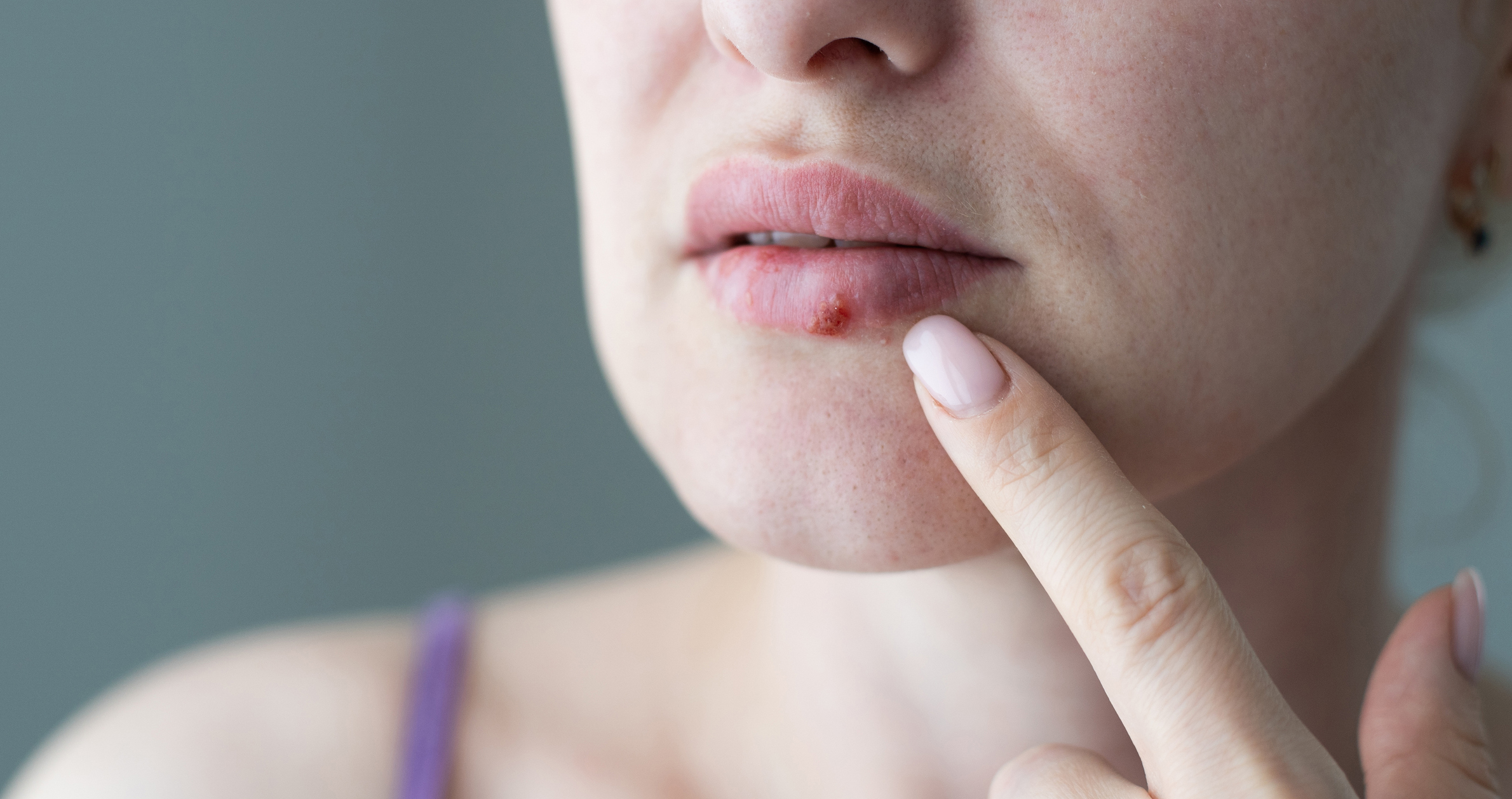 About our cold sore treatment at Park Avenue Dental Care